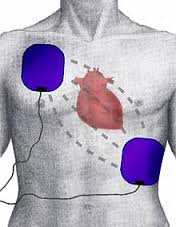 Defibrillator pad placement diagram